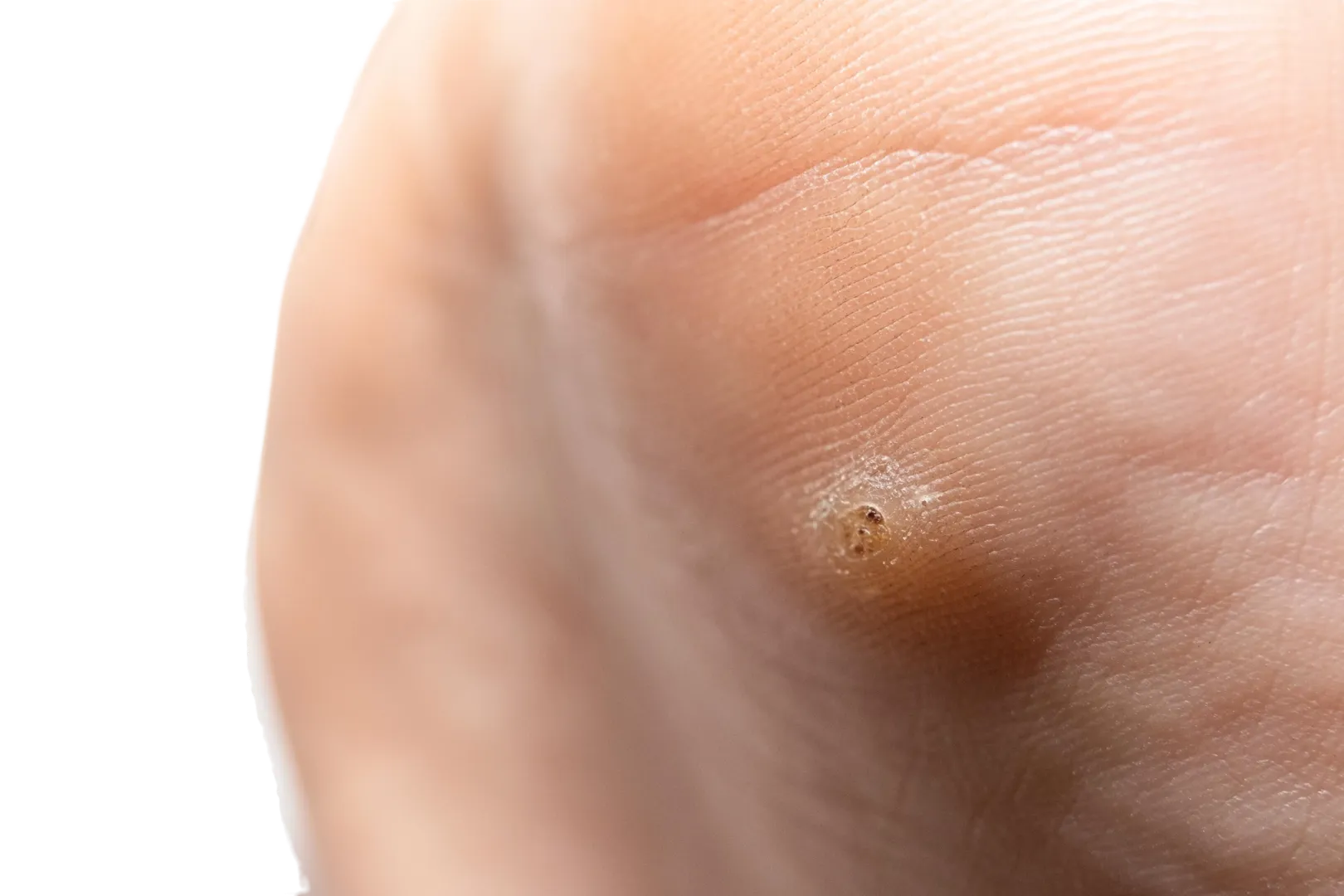 imagen de pie mostrando una verruga plantar u ojo de pescado
